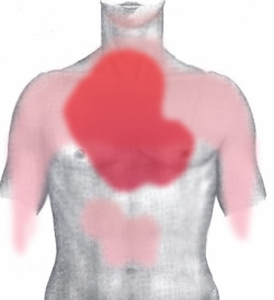 Front view of the main pain zones during an MI.